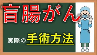 【一般の方向け】イラストで理解できる、盲腸癌の手術方法！消化器外科医が分かりやすく解説します。2022年、最新版盲腸癌　～手術解説編～