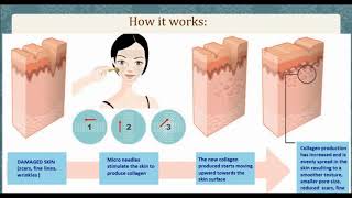 WEBINAR: Reverse Skin Damage with SilkPeel® Treatments