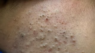 [ASMR] Satisfying Blackhead Removal and Deep Pore Cleansing Techniques,Satisfying Skincare Routine
