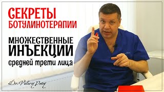 Множественные инъекции средней трети лица. Секреты ботулинотерапии. Dr.Valeriy Potiy