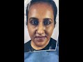 long face concave face underbite correction by jaw surgery best maxillofacial surgery in india