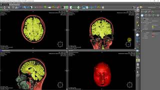 Marked watershed segmentation: MRI brain tissue segmentation