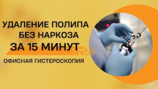 Офисная гистероскопия | Гистерорезектоскопия | Удаление полипа матки без наркоза