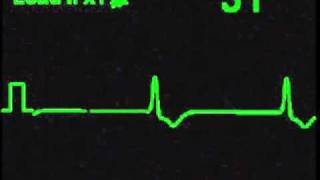 Idioventricular Rhythm - ECG Simulator - Arrhythmia Simulator