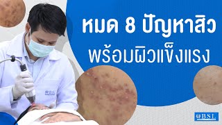 รักษาสิว | EP.73 | สิว ทุกประเภท รักษาสิวให้ผิวแข็งแรง สุขภาพดี | BSL Clinic