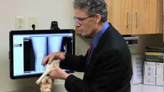 Knee Replacement Springfield, Knee Replacement Surgery Orthopedic Surgeon  Dr Romanelli OCI Ill.