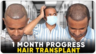 Hair Transplant in Mehsana | Best Results \u0026 Cost of Hair Transplant in Mehsana