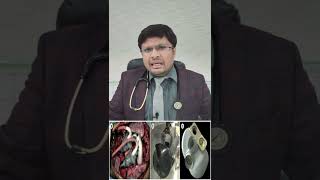 हार्ट फ़ैल होने पर मेटालिक हार्ट लगा सकते है ? TOTAL ARTIFICIAL METALLIC HEART