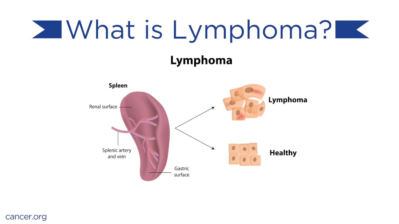 Lymphoma Causes And Treatments - YouTube