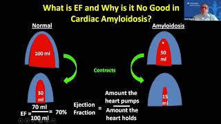 Cardiac Amyloidosis by Dr. Mat Maurer