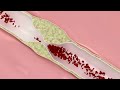 coronary atherosclerosis animation