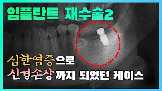 [대전치과, 대전 임플란트] 임플란트 재수술2 - 심한염증으로 신경손상까지 되었던 케이스