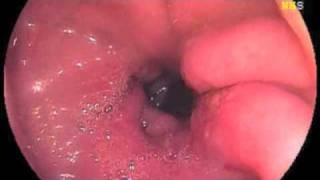 Stomach Ulcer Video