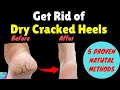 How do you Get Rid of Dry Cracked Heels Fast? | Home Remedy to Remove Cracked Heels Fast