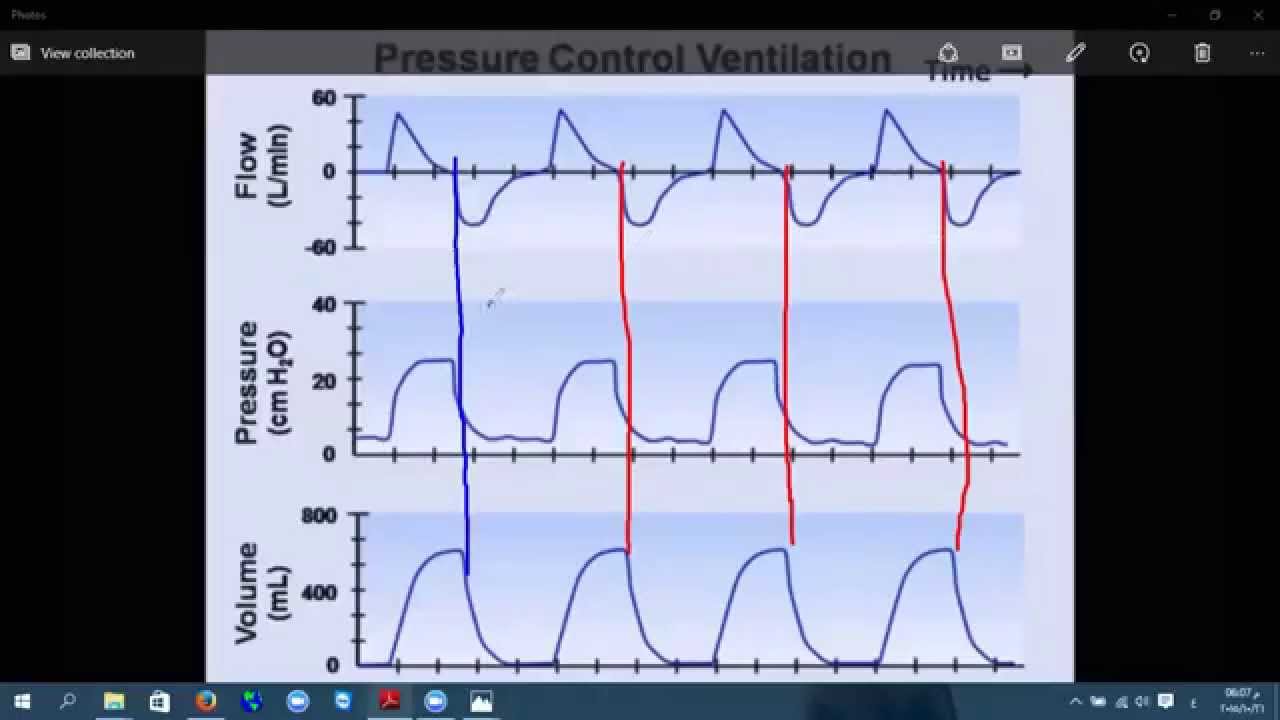 Mechanical Ventilation Principles 2 - YouTube