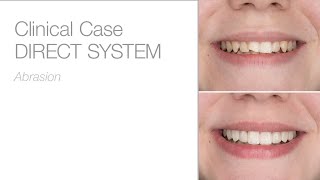 edelweiss DIRECT VENEER Transformation - Patient Story