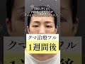 【脂肪注入でクマ治療】老けて見えるのが本当に悩みでした。 クマ取り クマ治療 脂肪注入 ダウンタイム 目の下のクマ取り