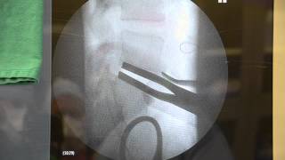 Lumbar Artificial Disc Replacement Surgery, Synthes Prodisc-L