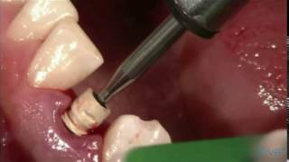 Xive™ Temporary restorations - Part 2 | Dentsply Sirona