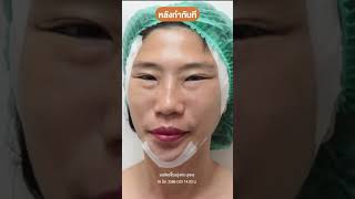 รีวิวหลังทำดึงหน้า #parinclinic #facelifts #shorts