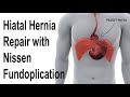 Hiatal Hernia Repair with Nissen Fundoplication to Treat Reflux Animation