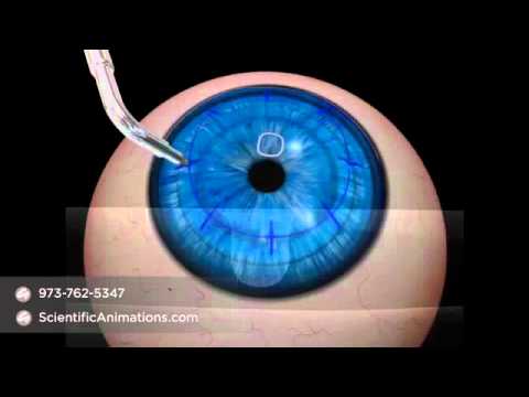 Conductive Keratoplasty Procedure - Ophthalmology Animation - YouTube