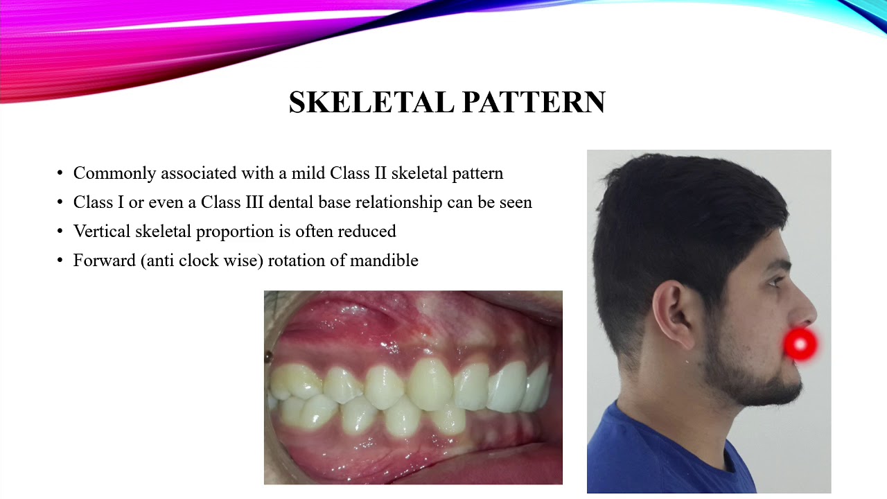 Class II Div 2 Malocclusion - YouTube