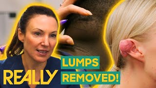 Dr. Emma Removes Painful Lipoma and Keloid From The Neck And Ear! | The Bad Skin