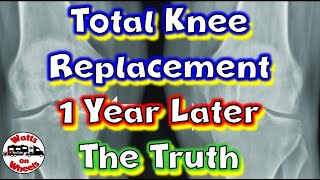 🦵Total Knee Replacement One Year Later // Why // Biggest Problem // Tips // How I'm Doing Today