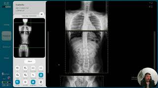 How to Perform Full Spinal X-Ray Image Stitching in RADMAX