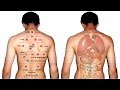Download 10 Amazing Benefits Of Cupping Therapy | Cure AIDS, Cancer, Diabetes, Lupus, Epilepsy & More In Mp4 3Gp Full HD Video