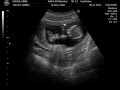 14 week ultrasound. It's a Boy! 14 week ultrasound. It's a Boy!