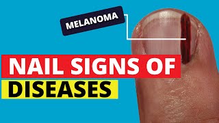 10 Nail Signs of Health Problems (Subungual Melanoma, Finger Clubbing, Nail Pitting, Brittle Nails)