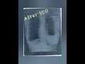 Lungs Infection and fluid accumulation #pulmonary#lungsinfection#radiology#xray#nursing#1kviews 💉💊🏥