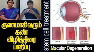 குணமாகிவரும் கண் விழித்திரை பாதிப்பு || Macular Degeneration