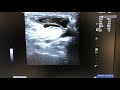 baker s cyst aspiration