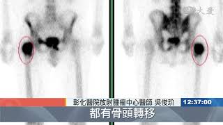 腿骨痠痛誤為骨刺 檢查竟是攝護腺癌