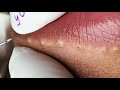 BEAUTY OF SQUEEZE😨 BLACKHEADS REMOVAL FROM THE LIPS #2  #relaxing  #blackheads