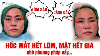 ĐỨNG HÌNH trước kết quả Bác sĩ Tú Dung CẤY MỠ MẶT cho Quý cô U60 HỐC MẮT LÕM SÂU trẻ ra 20 TUỔI