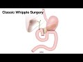 HCC 1475-10e-Surgical Anatomy-Classic Whipple