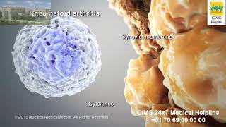 Rheumatoid Arthritis – CIMS Hospital