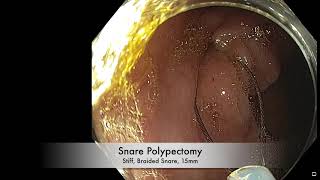 En Bloc Resection of a Sessile Cecal Polyp