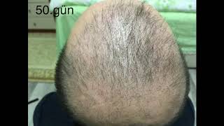 Hair transplant first 6 months with photos