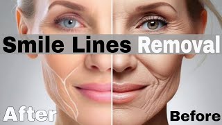 SMILE LINES (LAUGH LINES) REMOVAL AND Face Fat Loss Face Exercises #face yoga