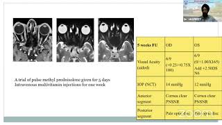 AIOC2021- GP64 - Topic - Dr.Jaspreet Sukhija - Toxic Optic Neuropathy