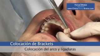Colocación de Brackets