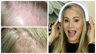 💝 HAIR LOSS SOLUTION! | I TRIED HAIRMAX LASERBAND 82  💝