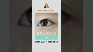 Dual Canthoplasty | Answer Plastic Surgery #shorts #dualcanthoplasty