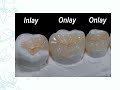 introduction to fixed prosthodontics