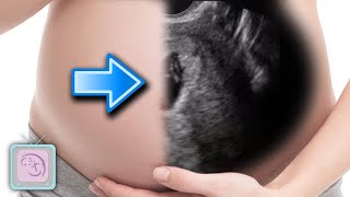 How to predict if you will have an early miscarriage (with ultrasound)